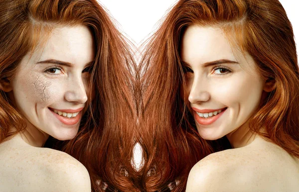 Young woman with dehydrated skin before and after treatment. — Stock Photo, Image