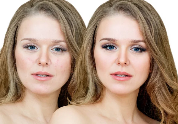 Жінка з прищами до і після лікування і макіяжу . — стокове фото
