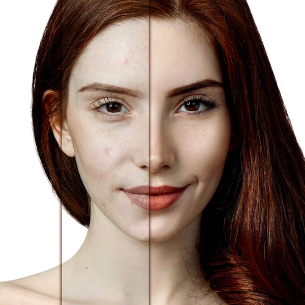 Femme rousse avec acné avant et après le traitement . — Photo