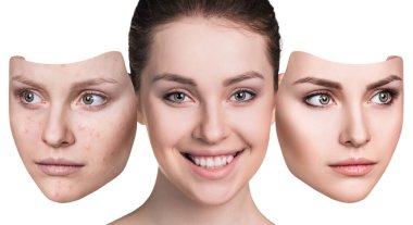 Woman wth acne before and after treatment and make-up.