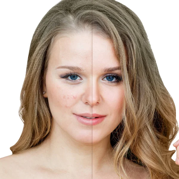 Donna con acne prima e dopo il trattamento e il trucco. — Foto Stock