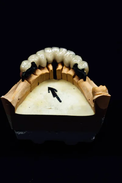 Campione Mandibola Gesso Individuale Primo Piano Odontoiatria Concetto Dettagli Processo — Foto Stock
