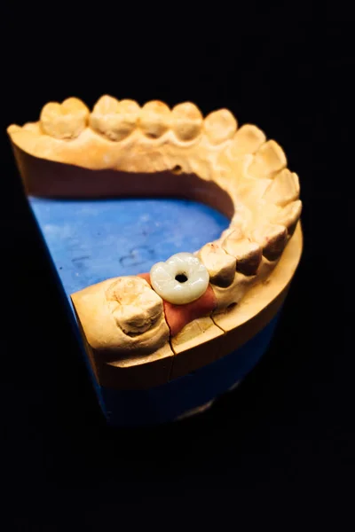 Sample Individual Plaster Jaw Close Dental Dentistry Process Details Concept — Stock Photo, Image