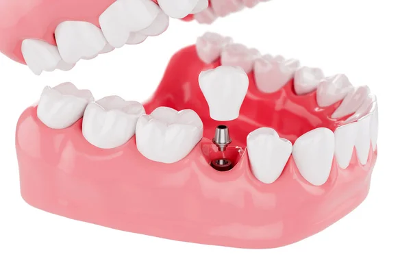 プロセスを閉じる白い背景に歯の健康管理をインプラントします 選択的フォーカス 3Dレンダリング — ストック写真