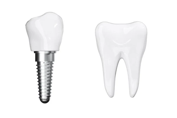 Isoler Fermer Processus Implants Avec Beauté Dents Blanches Sur Fond — Photo