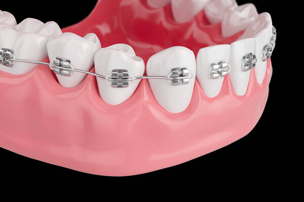 Close up Process Health Teeth with Brace. Selective focus. 3D Render.