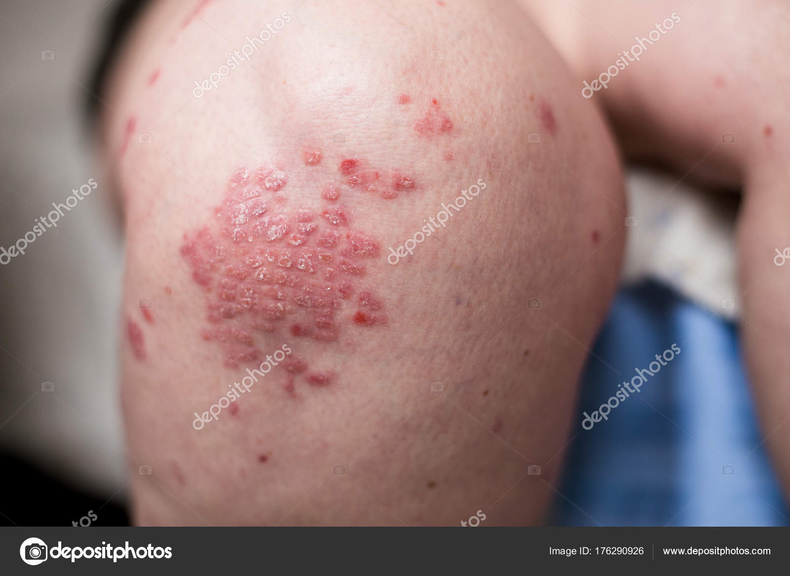 psoriasis and dermatitis together)
