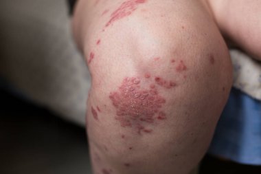 Sedef, egzama, Atopik dermatit bacak cilt üzerinde bir beyaz bir kadın. Deri döküntüleri kişi Alerjik reaksiyon gelen