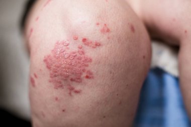Sedef, egzama, Atopik dermatit bacak cilt üzerinde bir beyaz bir kadın. Deri döküntüleri kişi Alerjik reaksiyon gelen