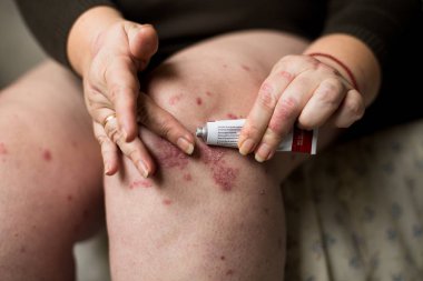 Sedef hastalığı tedavisinde olduğu gibi lapa lapa cilt kuruması için krem bir yumuşatıcı uygulayarak, egzama ve diğer kuru cilt tipleri