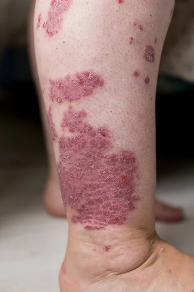 One Caucasian woman with psoriasis, eczema, atopic dermatitis on the skin of leg. Skin rashes from contact allergic reaction