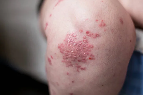 En hvid kvinde med psoriasis, eksem, atopisk dermatitis på benets hud. Hududslæt fra kontaktallergi - Stock-foto