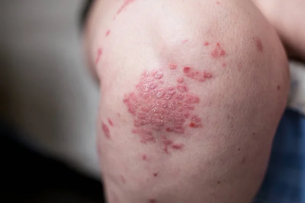 One Caucasian woman with psoriasis, eczema, atopic dermatitis on the skin of leg. Skin rashes from contact allergic reaction — Stock Photo, Image