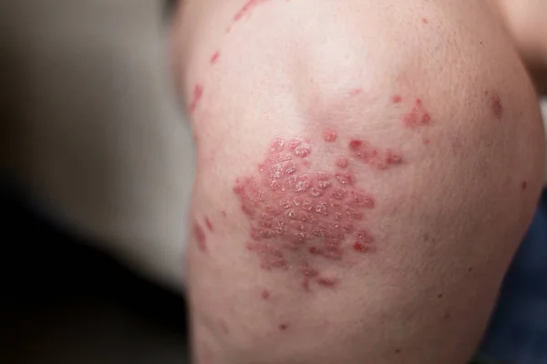 One Caucasian woman with psoriasis, eczema, atopic dermatitis on the skin of leg. Skin rashes from contact allergic reaction