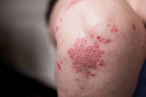 Una mujer caucásica con psoriasis, eccema, dermatitis atópica en la piel de la pierna. Erupciones cutáneas por reacción alérgica de contacto — Foto de Stock