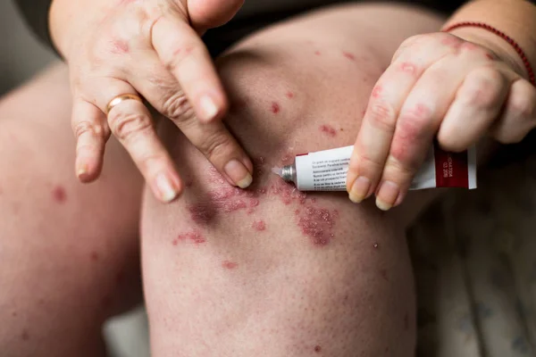 Aplicar un emoliente cremoso sobre la piel seca y escamosa, como en el tratamiento de la psoriasis, el eccema y otras afecciones de la piel seca — Foto de Stock