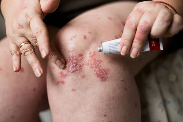 Aplicar un emoliente cremoso sobre la piel seca y escamosa, como en el tratamiento de la psoriasis, el eccema y otras afecciones de la piel seca —  Fotos de Stock