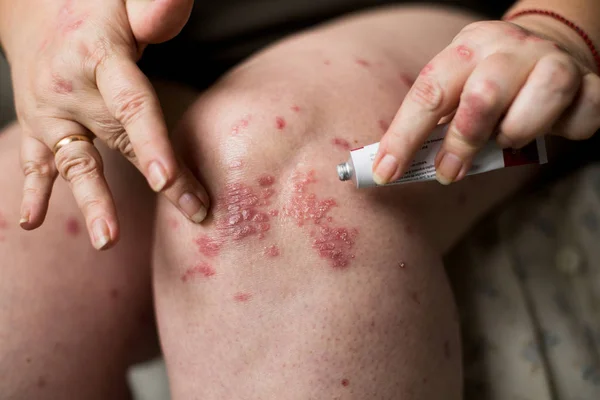 Aplicando um emoliente creme para secar a pele escamosa como no tratamento da psoríase, eczema e outras condições de pele seca — Fotografia de Stock