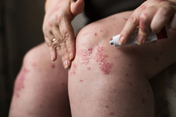 Aplicando um emoliente creme para secar a pele escamosa como no tratamento da psoríase, eczema e outras condições de pele seca — Fotografia de Stock