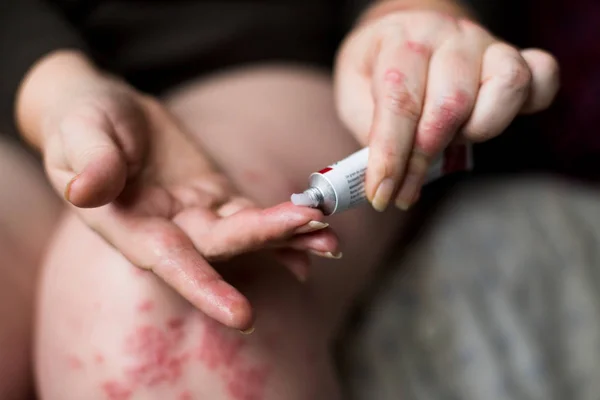 Aplicando um emoliente à pele seca escamosa como no tratamento da psoríase, eczema e outras condições de pele seca. Mulheres aplicando creme braço, coceira, conceito com cuidados de saúde e medicina . — Fotografia de Stock