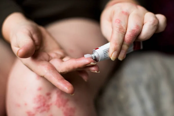 Aplicando um emoliente à pele seca escamosa como no tratamento da psoríase, eczema e outras condições de pele seca. Mulheres aplicando creme braço, coceira, conceito com cuidados de saúde e medicina . — Fotografia de Stock