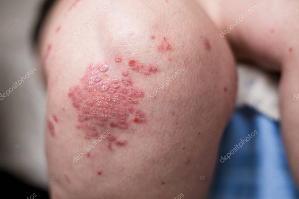 Una mujer caucásica con psoriasis, eccema, dermatitis atópica en la piel de la pierna