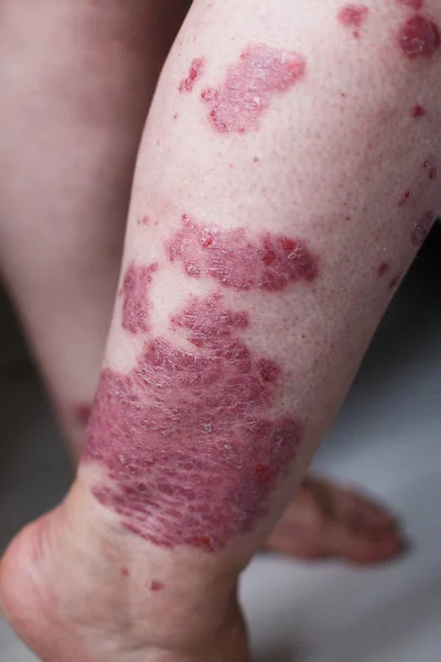 Erupción alérgica dermatitis eccema piel en la pierna del paciente. Psoriasis y eczema piel con grandes manchas rojas —  Fotos de Stock