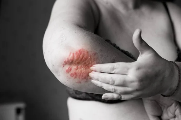 Mancha vermelha de dor na mão da mulher com erupção cutânea eczema ou alergia. Foto conceitual sobre cuidados de saúde e problemas de pele. Psoríase atópica fechar a pele . — Fotografia de Stock