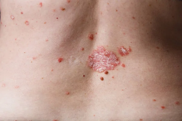 Rückenansicht von Frauen mit Dermatitis-Problem mit Hautausschlag und juckender trockener Haut. Ekzeme auf der Haut — Stockfoto