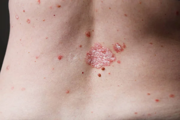 Rückenansicht von Frauen mit Dermatitis-Problem mit Hautausschlag und juckender trockener Haut. Ekzeme auf der Haut — Stockfoto