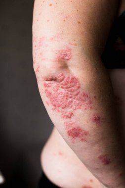 bir yumuşatıcı kuru lapa lapa cilt tedavisi, sedef, egzama ve diğer kuru cilt koşulları, kadın eli gibi uygulama