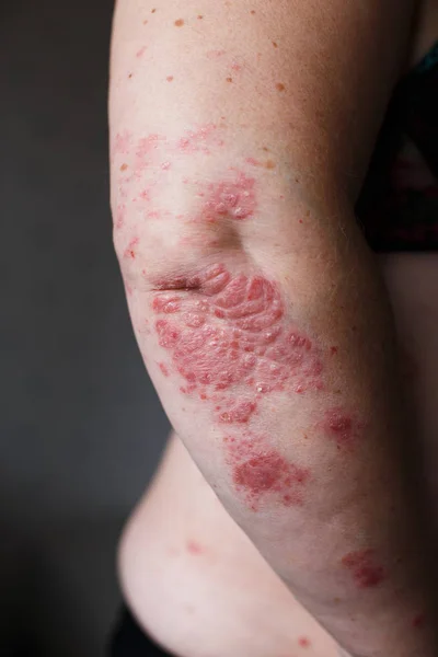 Appliquer un émollient sur peau squameuse sèche comme dans le traitement du psoriasis, de l'eczéma et d'autres affections cutanées sèches, la main de la femme — Photo