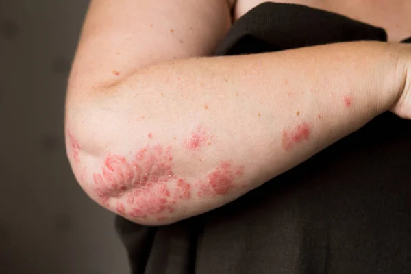 O problema com muitas pessoas - eczema na mão. Fundo escuro. Homem coceira pele . — Fotografia de Stock