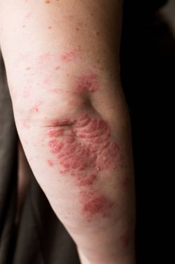 Egzama yandan birçok kişi ile-sorun. Koyu arka plan. Adam itchind cilt.