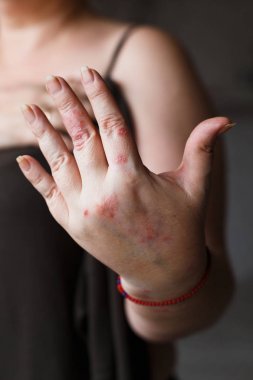 bir yumuşatıcı kuru lapa lapa cilt tedavisi, sedef, egzama ve diğer kuru cilt koşulları, kadın eli gibi uygulama