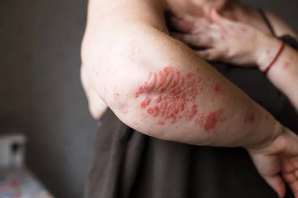 El problema con muchas personas - eczema en la mano. Fondo oscuro. Hombre picazón piel . —  Fotos de Stock