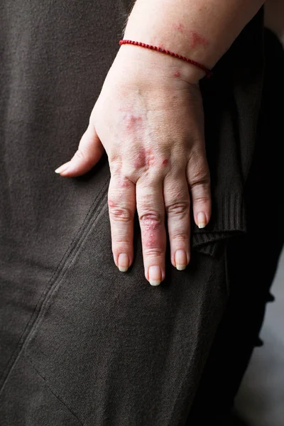 Aplicação de um emoliente para secar a pele escamosa como no tratamento da psoríase, eczema e outras condições de pele seca, mão da mulher — Fotografia de Stock