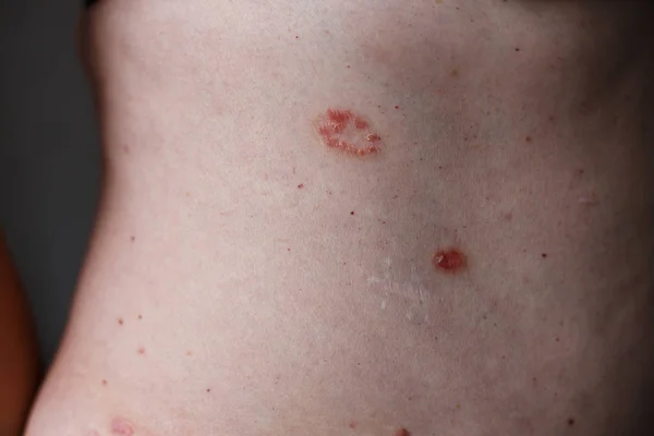 Pikkelysömör (pszoriázis, psoriasis) tünetei és kezelése