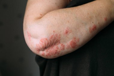 Psoriasis on elbow. Closeup photo of dry flaky skin with red spots clipart