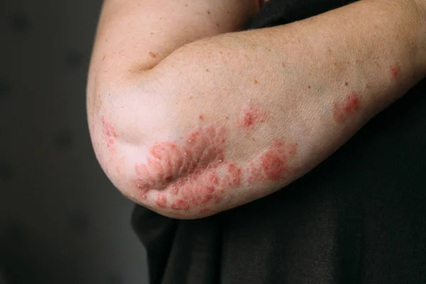 Psoriasis en el codo. Foto de primer plano de piel seca escamosa con manchas rojas — Foto de Stock