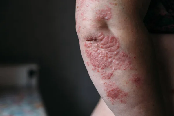 Psoriasis på albuen. Closeup foto af tør flaky hud med røde pletter - Stock-foto