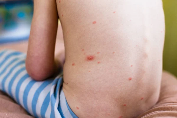 Boy with chicken pox rashon on the back — Stock Photo, Image