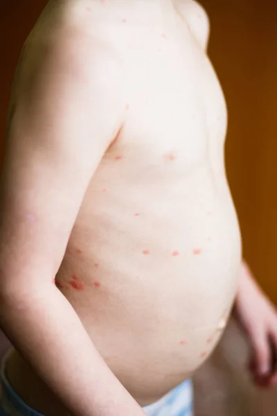 水痘の赤い斑点を持つ赤ちゃん — ストック写真