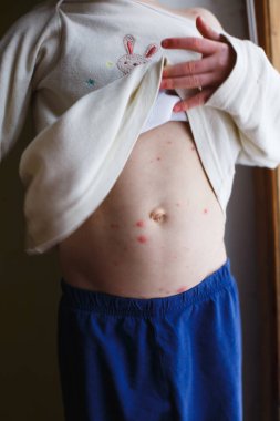 Bebek Tavuk Pox'u döküntü ile. Varisella virüs ya da su çiçeği kabarcık döküntü çocuk üzerinde. Dermatoloji kavramı. Yürümeye başlayan çocuk lekeleri karnı üzerinde gösterir.