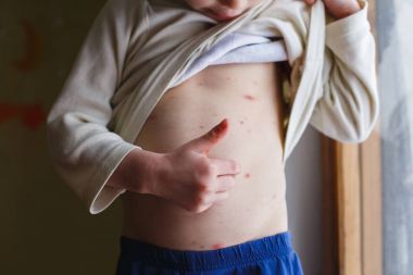 Bebek Tavuk Pox'u döküntü ile. Varisella virüs ya da su çiçeği kabarcık döküntü çocuk üzerinde. Dermatoloji kavramı. Yürümeye başlayan çocuk lekeleri karnı üzerinde gösterir.