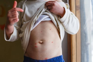 Bebek Tavuk Pox'u döküntü ile. Varisella virüs ya da su çiçeği kabarcık döküntü çocuk üzerinde. Dermatoloji kavramı. Yürümeye başlayan çocuk lekeleri karnı üzerinde gösterir.