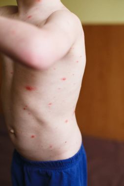 Bebek Tavuk Pox'u döküntü ile. Varisella virüs ya da su çiçeği kabarcık döküntü çocuk üzerinde. Dermatoloji kavramı