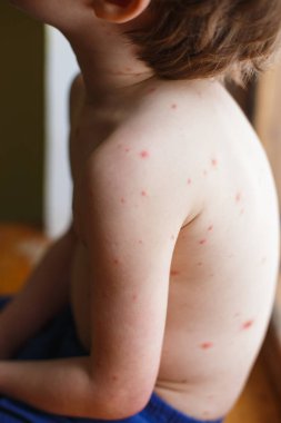 Bebek Tavuk Pox'u döküntü ile. Varisella virüs ya da su çiçeği kabarcık döküntü çocuk üzerinde. Dermatoloji kavramı