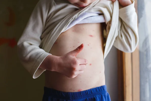 Bebek Tavuk Pox'u döküntü ile. Varisella virüs ya da su çiçeği kabarcık döküntü çocuk üzerinde. Dermatoloji kavramı. Yürümeye başlayan çocuk lekeleri karnı üzerinde gösterir.