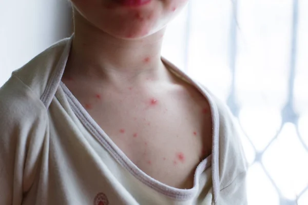 Bebek Tavuk Pox'u döküntü ile. Varisella virüs ya da su çiçeği kabarcık döküntü çocuk üzerinde. Dermatoloji kavramı